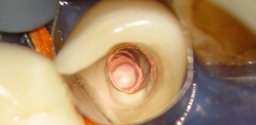 Nichtchirurgische Ultraschallinstrumente