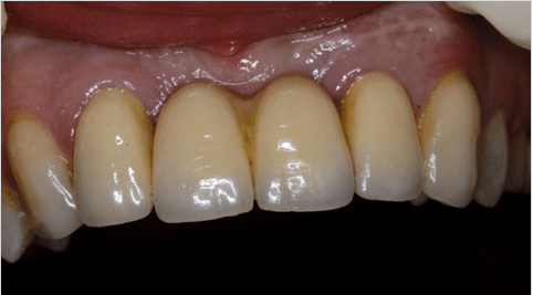 Implantate in der ästhetischen Zone