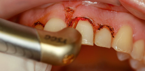 Chirurgische Kronenverlängerung: minimalinvasiv und schmerzarm ans Ziel