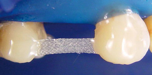 Moderne lichthärtende Fasersysteme eröffnen neue Möglichkeiten