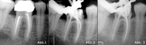Revision eines unteren Molaren mit frakturiertem Instrument