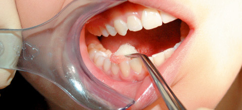 Ist die individuelle Fluoridierung sinnvoll?