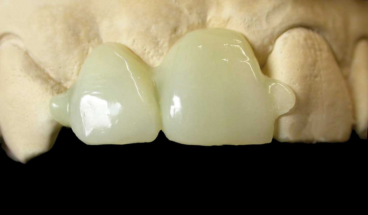 Langzeitprovisorien aus Polymer-Kunststoff