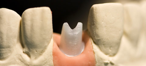 Zahn-Implantate in der "ästhetischen Zone": Entscheidend ist der langfristige Erfolg