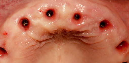 Der minimalinvasive Sinuslift