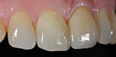 Vollkeramische Abutments – konfektioniert oder individuell?