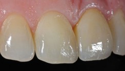 Vollkeramische Abutments – konfektioniert oder individuell?