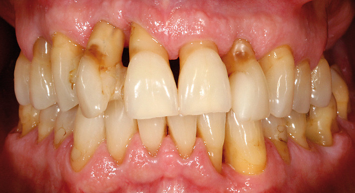 Die parodontale Problematik bei hormoneller Umstellung