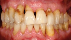 Die parodontale Problematik bei hormoneller Umstellung