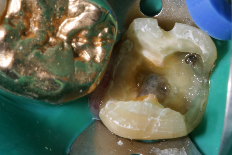 Diagnostik und Therapie von internen Resorptionen