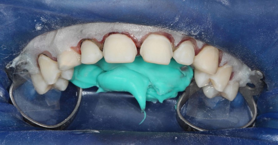 Kombinierte kieferorthopädisch-ästhetisch-rekonstruktive Therapie