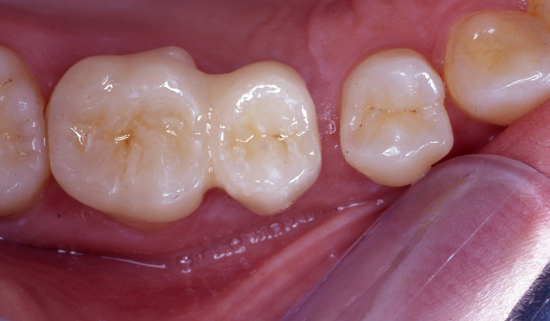 LS2-Restaurationen mit Extensionsglied