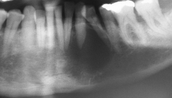 Sonografische Darstellung einer Zyste mit Knochendefekt