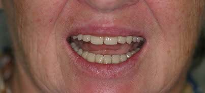 Doldersteg oder Vario-Soft-Steg?