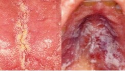 Parodontale Erkrankungen bei chronischer HIV-Infektion