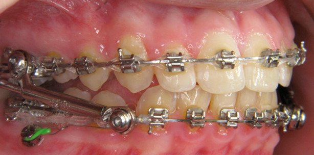 Weniger Nebeneffekte durch Minipins?