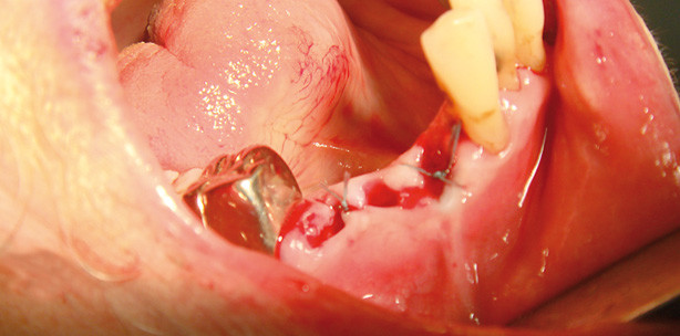 Orale Wundversorgung nach Maß