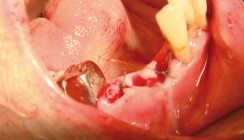 Orale Wundversorgung nach Maß