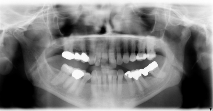 Schmerzfrei dank Laser und Chlorhexidin