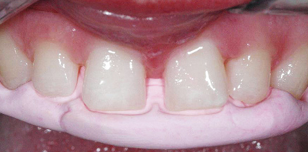 Mut zur Lücke muss nicht sein!