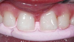 Mut zur Lücke muss nicht sein!