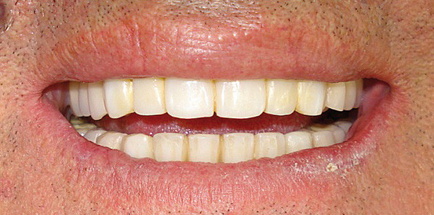 Deckprothesen mit Steganker