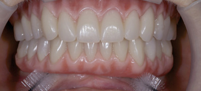 Brückenprothetik im zahnlosen Kiefer