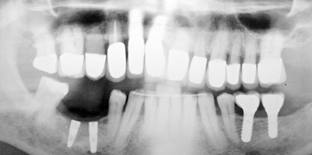 Abformung von Implantaten mit extremer Neigung