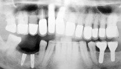 Abformung von Implantaten mit extremer Neigung