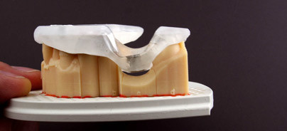 Navigierte Implantation ohne ­konventionelle Abformung – Ein Case-Report