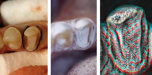 Die digitale Abformung im Praxistest
