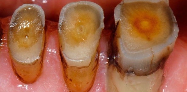 Erosion und Abrasion – ein lebenslanges Problem