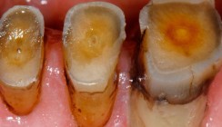 Erosion und Abrasion – ein lebenslanges Problem