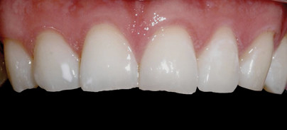 Abrasion, Erosion, Attrition: Was nun? Was tun?