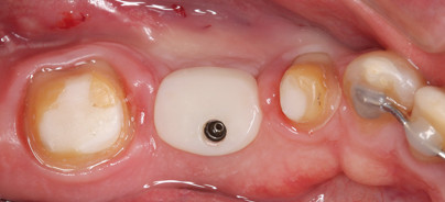 Vollkeramische Abutments – Vorbereitung und Design