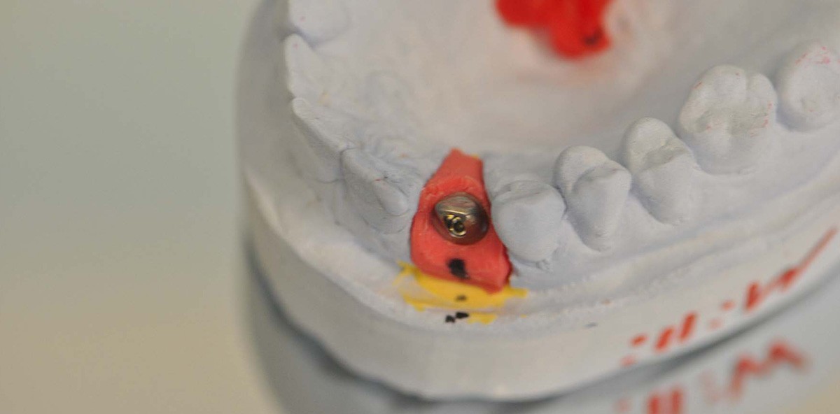 „One Abutment at one time“ – die Aufgaben des Zahntechnikers