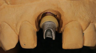 Individuelle Abutments gestern vs. heute