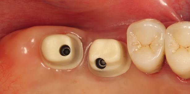 Individuelle Abutments im Seitenzahnbereich