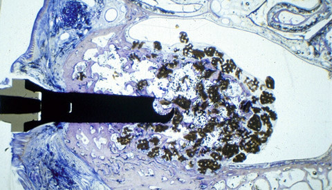 Biomaterialien für den Sinuslift