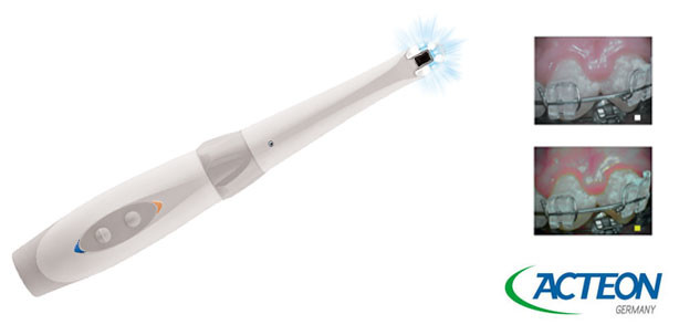 Ein neuer Blick auf Zahn & Co.: Fluoreszenzkamera SoproCare