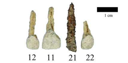 Wurden Implantate schon vor über 2.000 Jahren gesetzt?