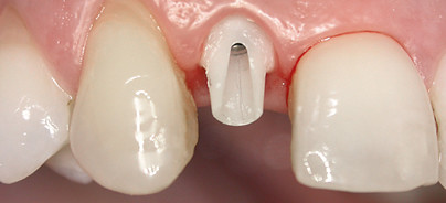 Langzeitstabilität und Ästhetik mit Implantatversorgung