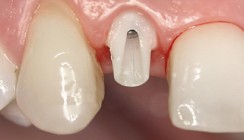 Langzeitstabilität und Ästhetik mit Implantatversorgung
