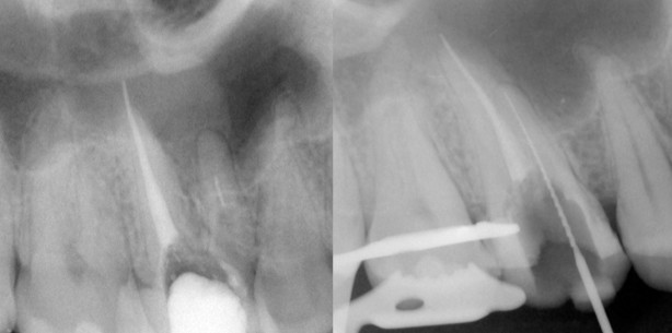 Sichere Instrumentenentfernung aus dem Wurzelkanal