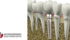 Aktionsbündnis gegen Periimplantitis