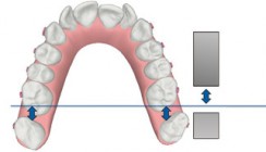 Aligner-Orthodontie in kombiniert kieferorthopädisch- kiefergesichtschirurgischen Konzepten