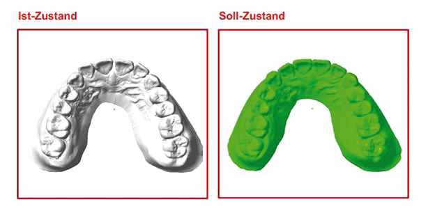 Der digitale CA® CLEAR-ALIGNER