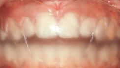 Zur Geschichte der Alignertherapie