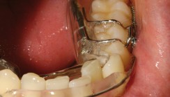 Perfektes Lächeln – mit minimalinvasiver Technik