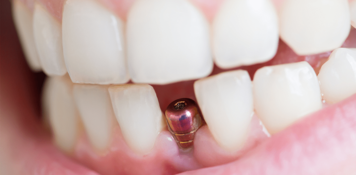 Wenn Zahnersatz Allergien auslöst – Was gilt es zu beachten? – ZWP online – das ...